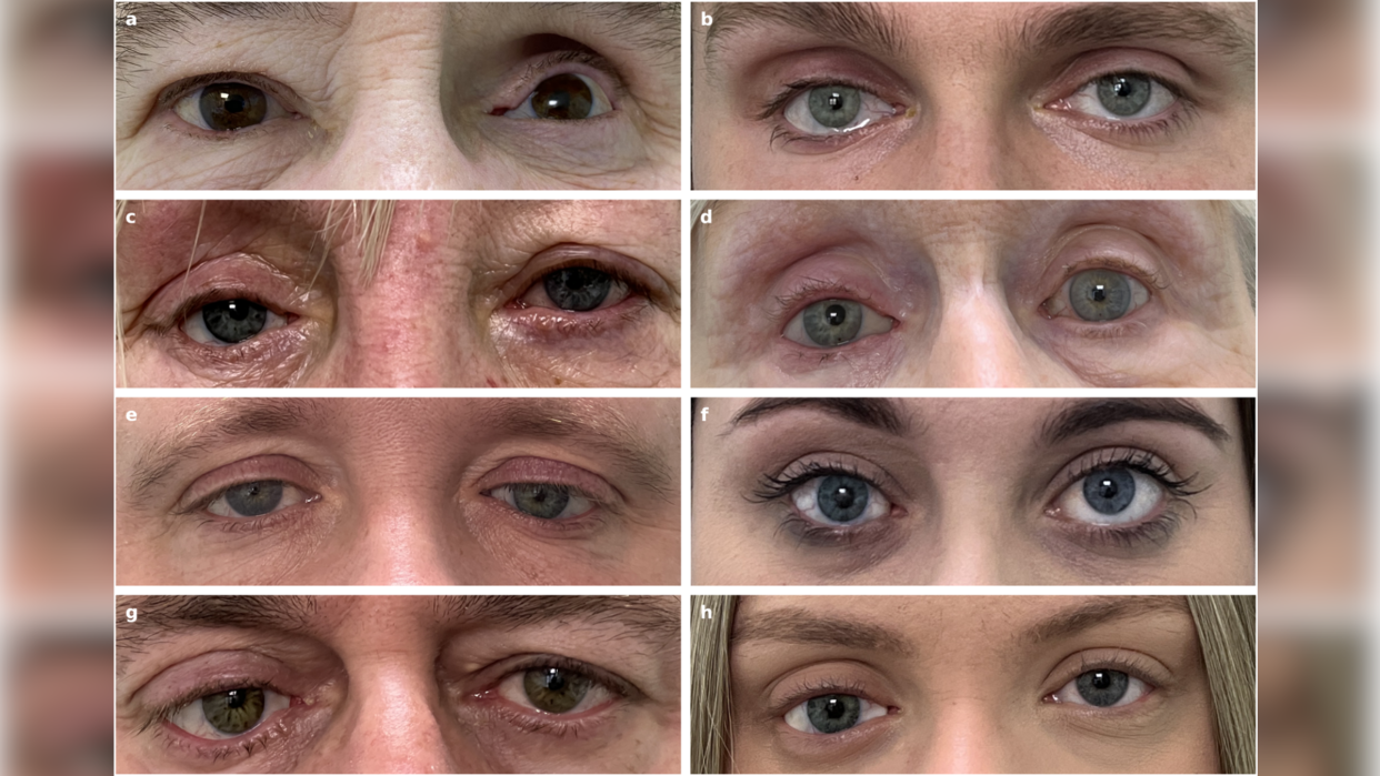  Grid of images of the eyes of eight patients who received a prosthetic eye in the new study. 