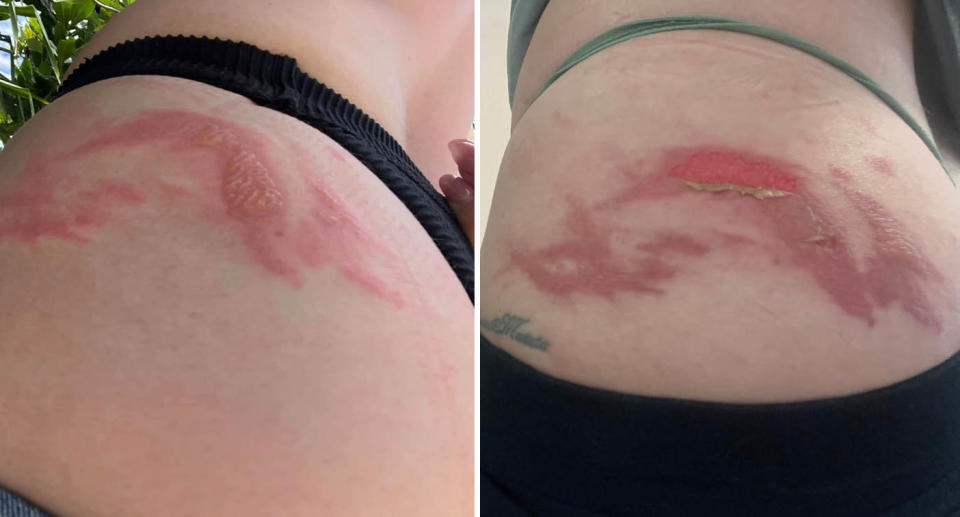 Two photos of the rashes Stephanie Moody picked up from tomcat beetles in Bali. The first photo shows the large rashes on the side of her leg, with a blister. In the second photo, the blister has popped.