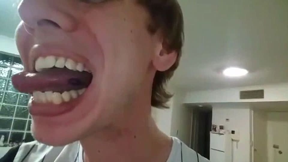 Lachlan Robinson found the blood sucking critter attached to his tongue after reportedly eating a bag of salad from Coles. Source: Facebook