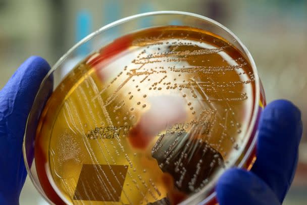 PHOTO: A microbiologist holding a blood agar plate showing the beta-hemolysis caused by pathogenic bacteria Streptococcus pyogenes. (STOCK PHOTO/Getty Images)