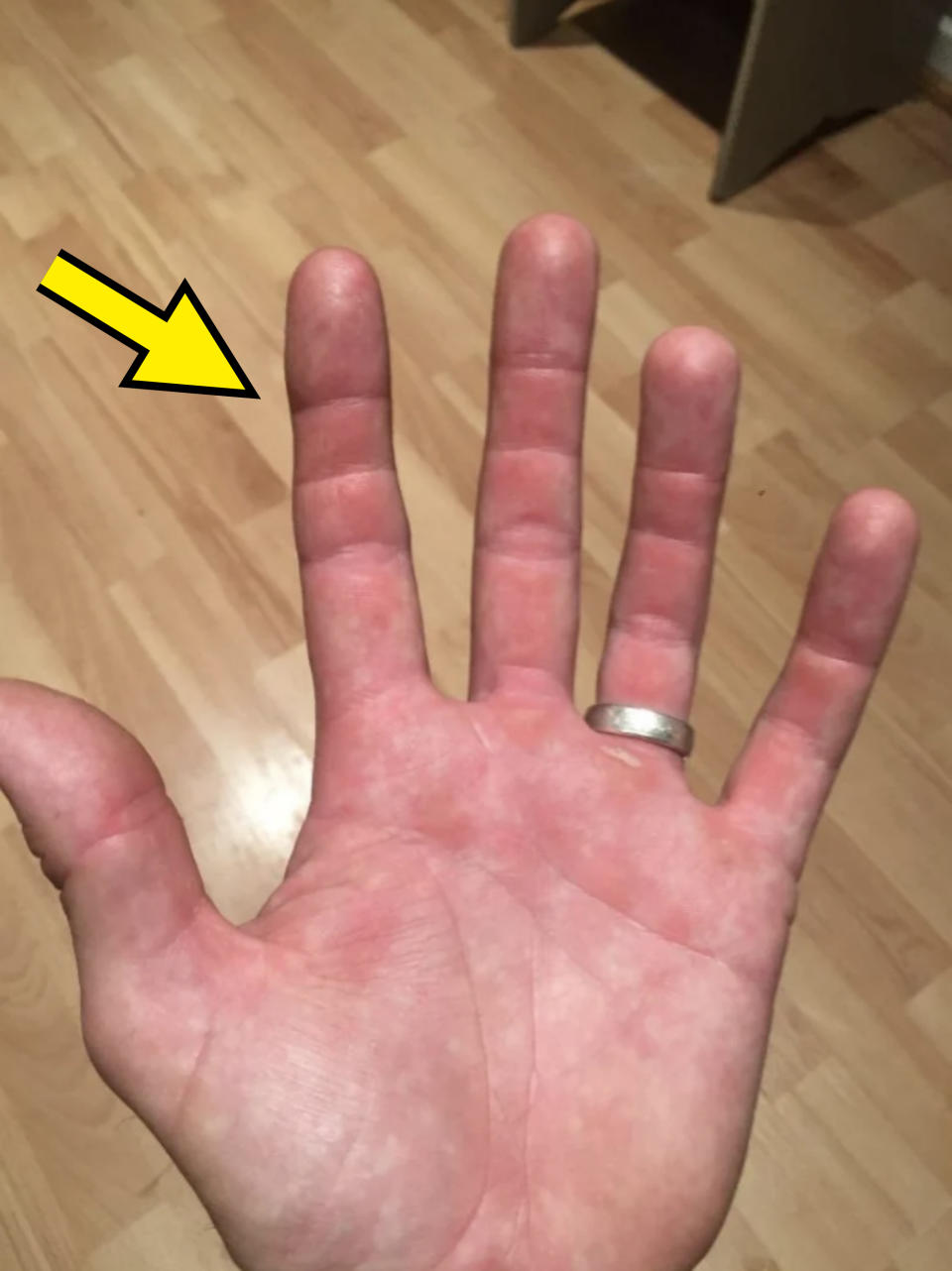 A close-up of a palm showing five fingers with a silver ring on the ring finger. The background is a wooden floor