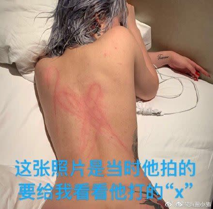 屈楚蕭在前女友黎梵背部留下大片傷痕。（圖／翻攝自黎梵微博）