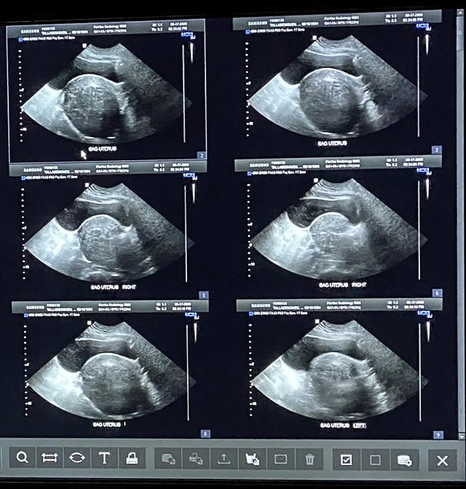 Cynthia Talla’s ultrasound showing uterine fibroids. (Courtesy Cynthia Talla)