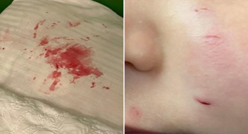 The toddler's injuries from the rat and blood on his pillow.