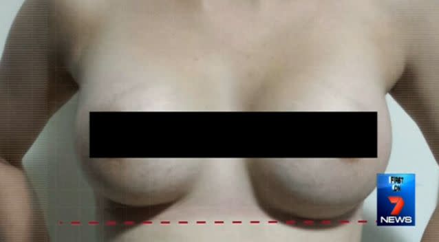 Another victim shares a photo their botched breast implants. Source: 7News