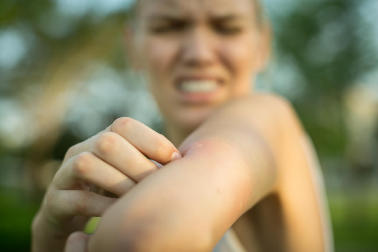 Person reacting to a bite on their arm. (Getty Images)