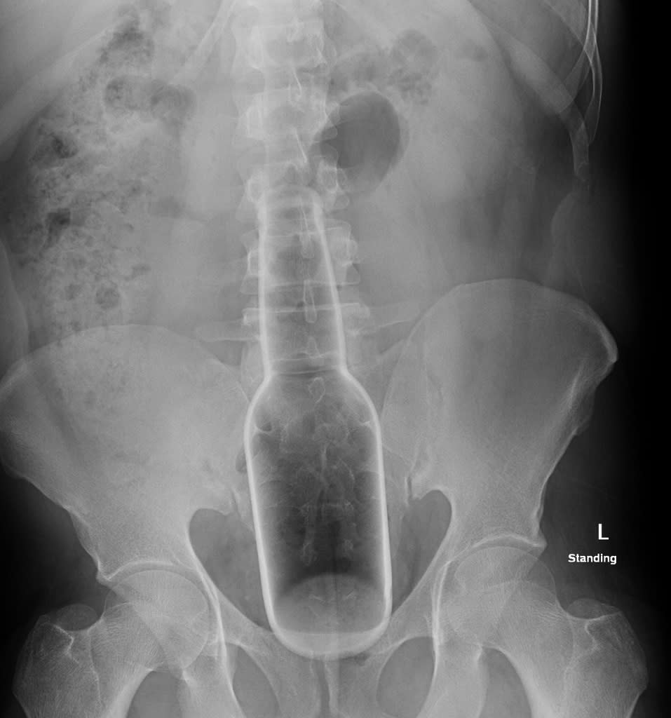 Botella de cerveza en colon y recto de paciente sin señal de perforación. Dr Daniel J Bell, <a href="https://radiopaedia.org/cases/rectal-foreign-body-18" rel="nofollow noopener" target="_blank" data-ylk="slk:Radiopaedia.org;elm:context_link;itc:0;sec:content-canvas" class="link ">Radiopaedia.org</a>