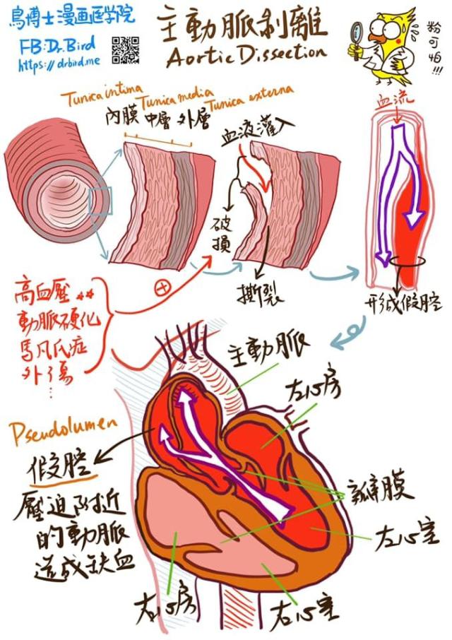 主動脈為何會剝離 醫po手繪圖揭 4原因 急性殺手