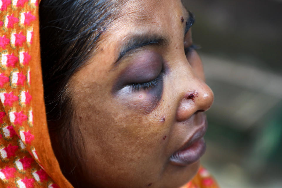 Mst. Saleha Begum 35 years old a woman garment worker has been injured by rubber bullet on her eye and hand during clashes between police and garment workers demanding fair wages protest day after tomorrow, poses for a photograph at Gazipur district, outback of Dhaka, Bangladesh on November 11, 2023.  
