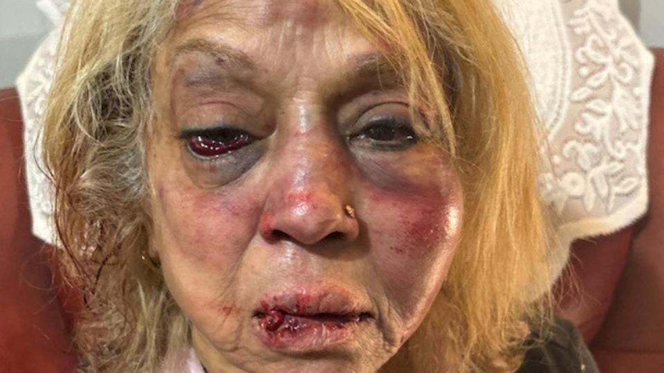 Ninette Simons received severe facial bruising and swelling after she was assaulted during a shocking home invasion. Picture: WA Police/Supplied