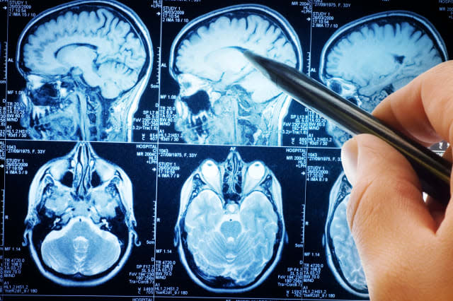 magnetic resonance image (MRI) of the brain