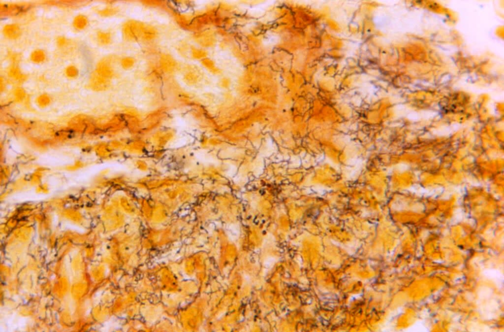 This 1966 microscope photo made available by the Centers for Disease Control and Prevention shows a tissue sample with the presence of numerous, corkscrew-shaped, darkly-stained, Treponema pallidum spirochetes, the bacterium responsible for causing syphilis. U.S. health officials on Monday, Sept. 19, 2022, are calling for a new push to prevent sexually transmitted diseases — spurred in part by a 26% increase in syphilis cases last year. (Skip Van Orden/CDC via AP)