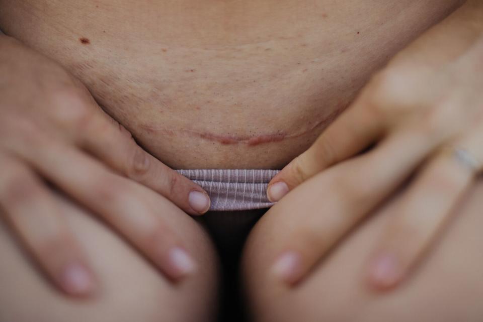 A woman lowers her underwear band to reveal a C-section scar