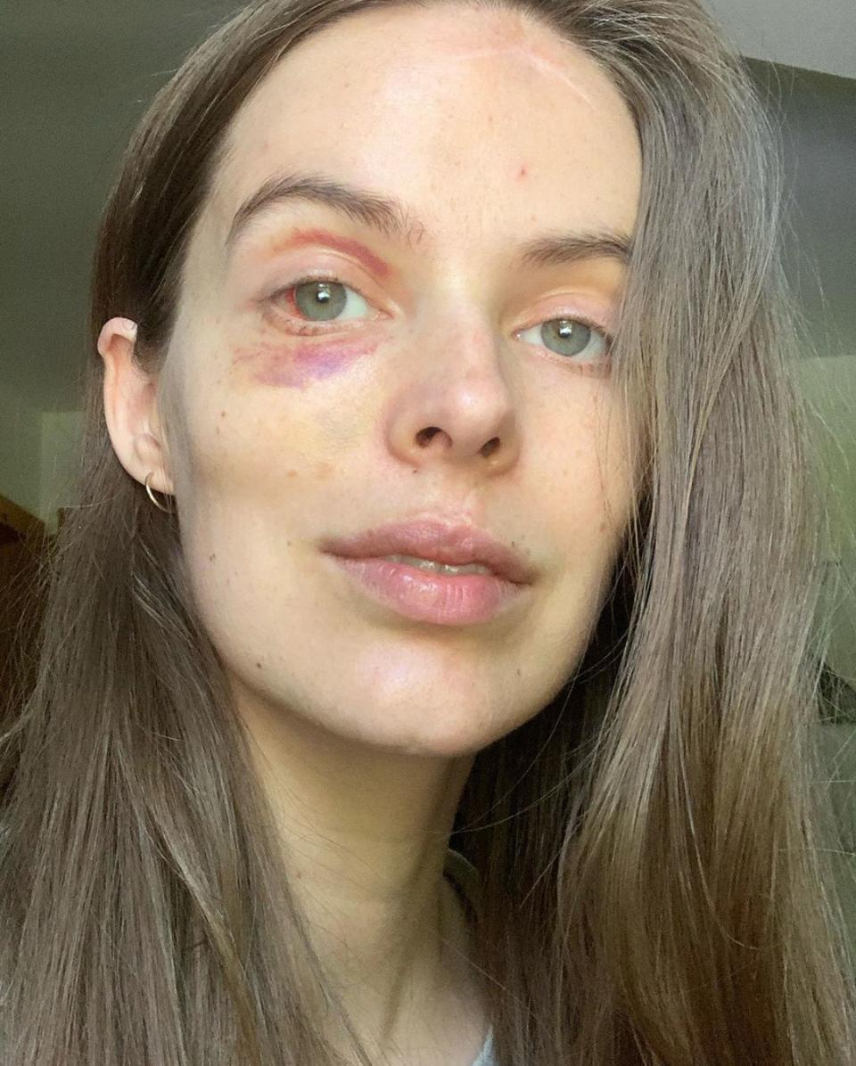 Robyn, who lives with the autoimmune condition lupus, shared another photo of her healing black eye. Photo: Instagram/robynlawley.