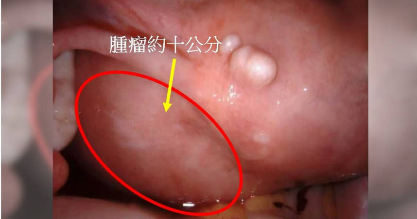 女子的子宮肌瘤有10公分大，若不切除恐壓迫輸尿管造成腎臟發炎。（圖／中醫大新竹附醫提供）