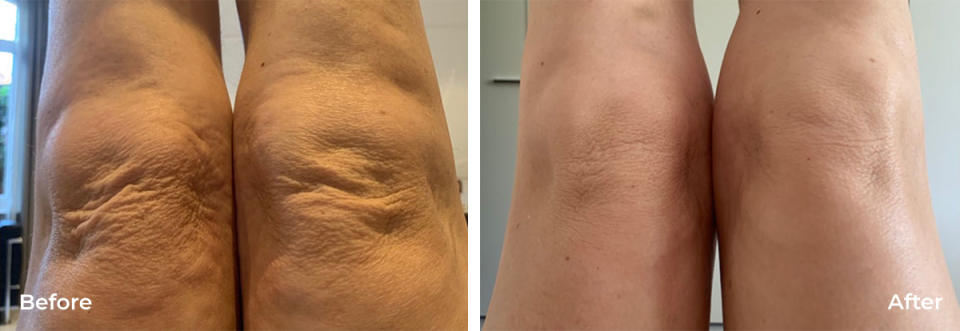 Knees before and after LYMA laser treatment