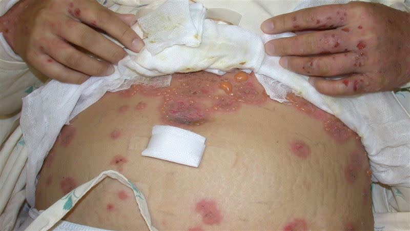 類天皰瘡出現搔癢的紅疹和多發性飽滿水泡。(圖/林口長庚提供)