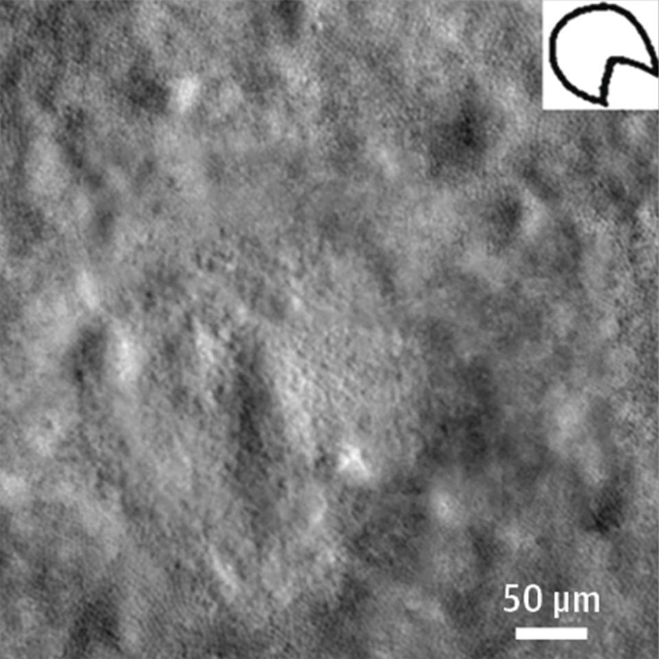 This microscope image provided by Mount Sinai’s New York Eye and Ear Infirmary shows damage to the retina of a person who viewed the 2017 eclipse without adequate protection, and a drawing by the patient showing the shape of what the visual artifact looks like to her. She complained of a black spot in her vision, and doctors discovered retinal damage that corresponded to the eclipse’s shape. (New York Eye and Ear Infirmary of Mount Sinai, JAMA via AP)