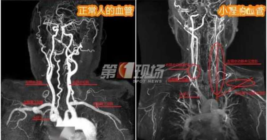深圳一名24歲女子患「東方美女病」，血管如高齡老人，誘因竟是相思病。（圖／翻攝自《第一現場》，下同）