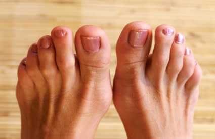 1. Red flag: Hairless feet or toes. What it means: Poor circulation, usually caused by vascular disease, can make hair disappear from the feet. When the heart loses the ability to pump enough blood to the extremities because of arteriosclerosis (commonly known as hardening of the arteries), the body has to prioritize its use. Hairy toes are, well, low on the totem pole. More clues: The reduced blood supply also makes it hard to feel a pulse in the feet. (Check the top of the foot or the inside of the ankle.) When you stand, your feet may be bright red or dusky; when elevated, they immediately pale. The skin is shiny. People with poor circulation tend to already know they have a cardiovascular condition (such as heart disease or a carotid artery) yet may not realize they have circulation trouble. What to do: Treating the underlying vascular issues can improve circulation. Toe hair seldom returns, but nobody complains much.