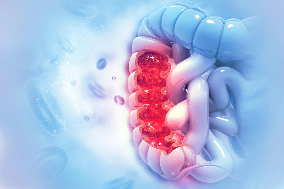 Image of a human colon bisected to show an reddish area exhibiting cancerous cells set against a bluish background.