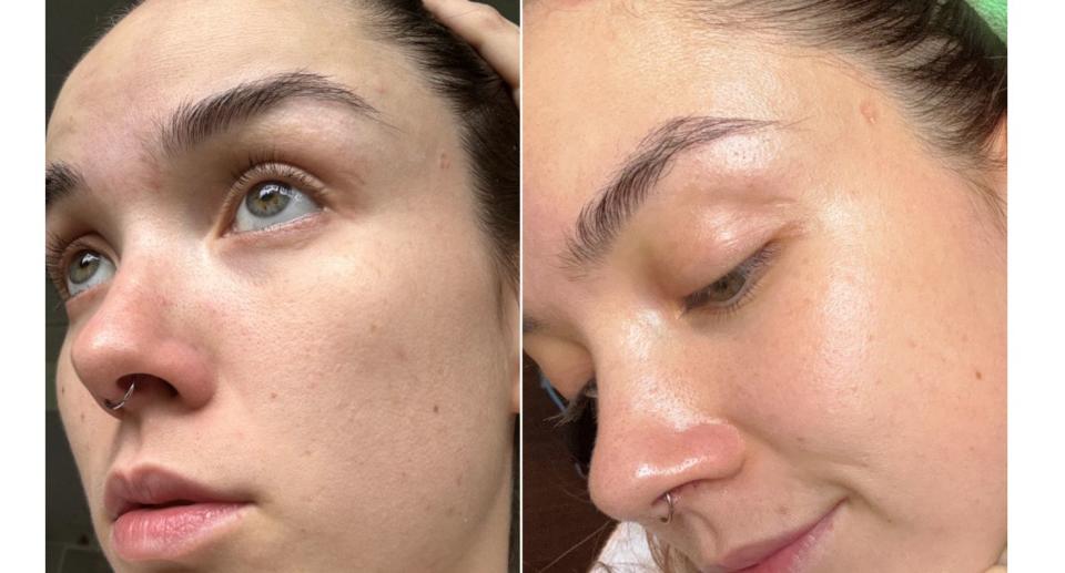 Before and after skin on woman