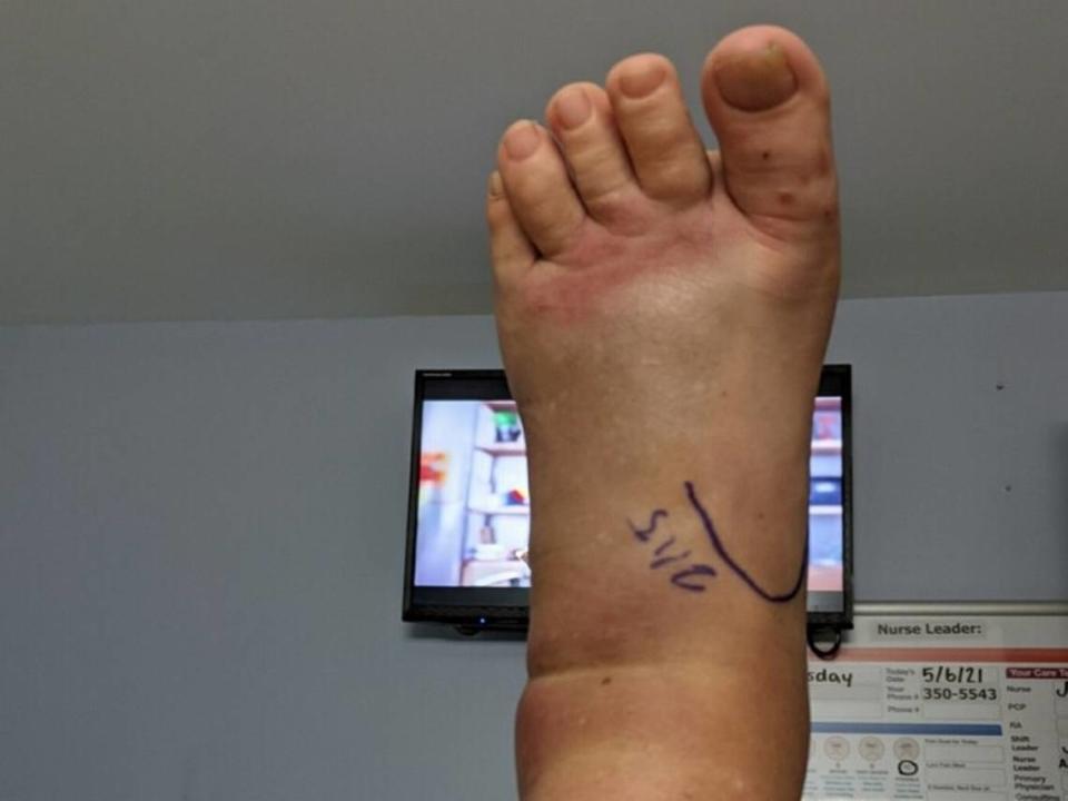 Susan Conlin O’Neil’s left foot after she was bit three times by a copperhead snake on Hilton Head May 5.