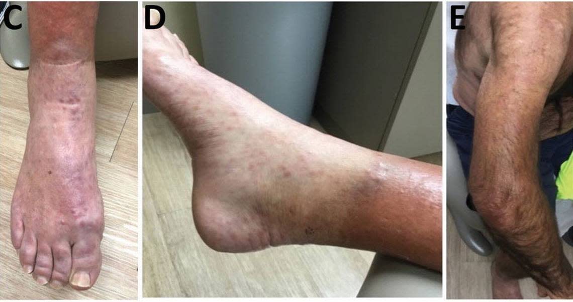 Leprosy, also called Hansen’s disease, in a 54-year-old man in Central Florida in 2022.