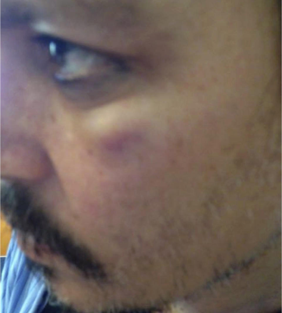 In this photo provided by London High Court on Thursday, July 16, 2020, actor Johnny Depp with injuries allegedly sustained from Amber Heard during an incident in Los Angeles in March 2015, which was filed with the witness statement of Sean Bett, and has been referred to as an exhibit in the hearing of Depp's libel case at the High Court in London. Depp is suing News Group Newspapers, publisher of The Sun, and the paper’s executive editor, Dan Wootton, over an April 2018 article that called him a “wife-beater.” The Sun’s defense relies on a total of 14 allegations by his ex-wife Amber Heard of Depp’s violence. He strongly denies all of them. (London High Court via AP)