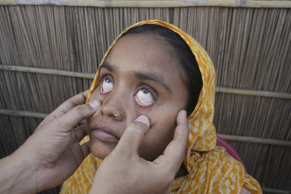A heart officer checks the eyes of 25-year-old Jahanara Khatoon, who is at full-term pregnancy, in Sandoh Khaiti Char, in the northeastern Indian state of Assam, Wednesday, July 3, 2024. (AP Photo/Anupam Nath)