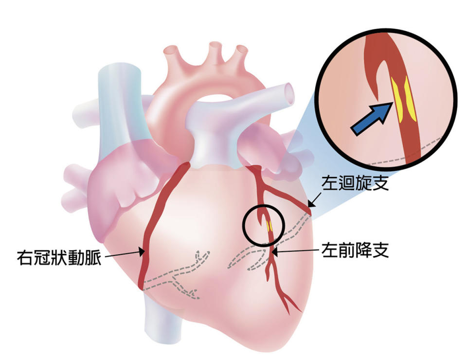 冠狀動脈粥狀血管硬化，當冠狀動脈的血管壁裡面有不好的油(黃色處)堆積，而造成血管阻塞時，血管的血流量就會變小。 圖片出處：謝美玲、陳郁志等(2019冠狀動脈粥狀硬化心臟病之心導管檢查須知)P.5