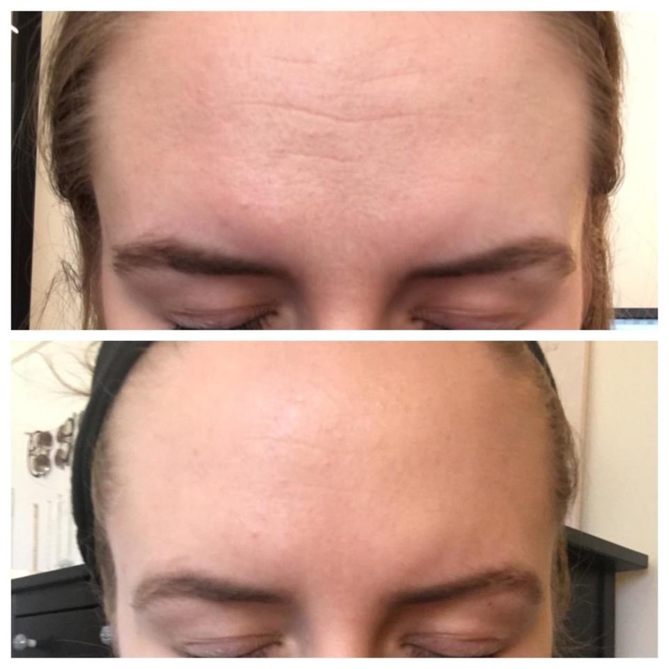 A reviewer's forehead in two images: on top with more pronounced wrinkles, on the bottom with reduced lines