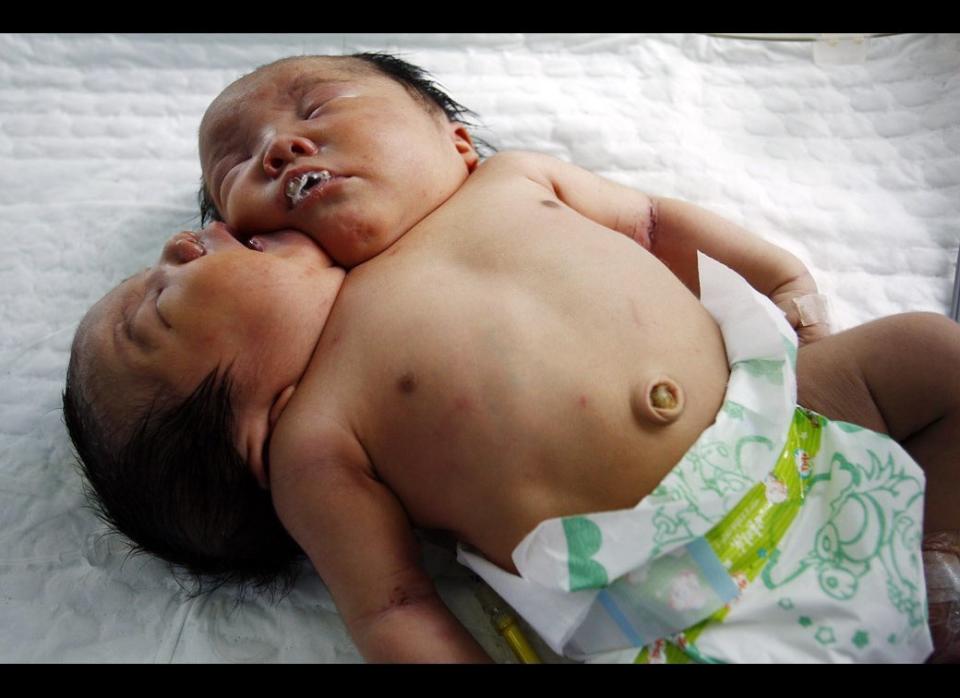 The two-headed conjoined female twin babies in a hospital on May 9, 2011 in Suining city in southwest China's Sichuan province. The twins were born on May 5, 2011 by caesarean. Two previous ultrasound scans in September and February both reported a single embryo to her mother Bao Qiaoying, a migrant worker, until a check on May 3rd found it had two heads. The parents wanted to abort the fetus but it was already too late. The hospital says they are China's first reported two-headed conjoined twin babies, born 4.05kg together.  
