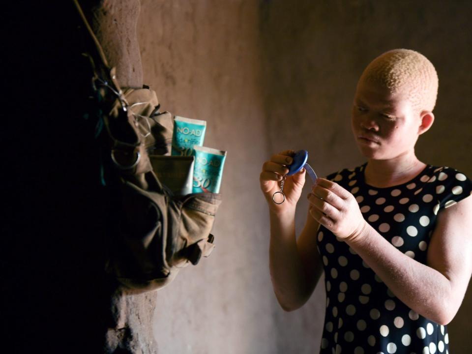 Albinism in Africa. Malawi. February 2020.