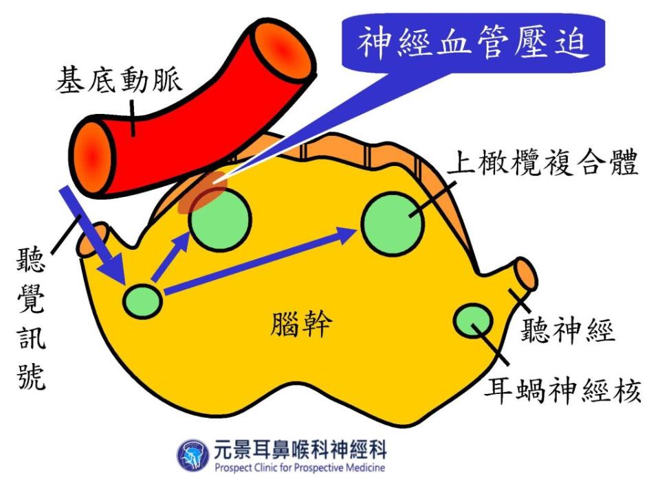 基底動脈扭曲，管徑擴大致壓迫腦幹，當動脈搏動突然增加，猛然撞擊腦幹，局部組織發生形變，干擾上橄欖複合體內聽覺訊號的傳遞。（醫師陳建志提供）