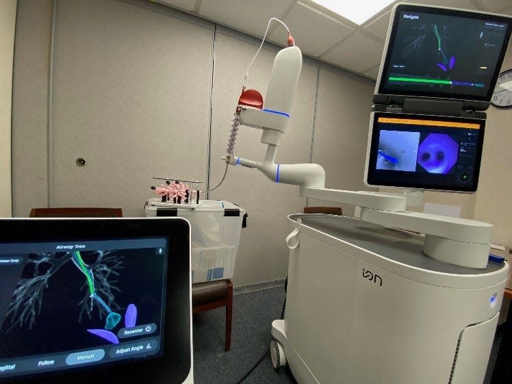 Ion, a specialized piece of equipment used to diagnose lung cancer that uses a robot-assisted biopsy of the lung, is being used at OhioHealth Marion General Hospital. Patients will no longer have to travel to Columbus for this type of procedure.