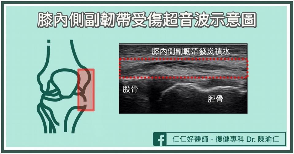 膝內側副韌帶受傷的分級？