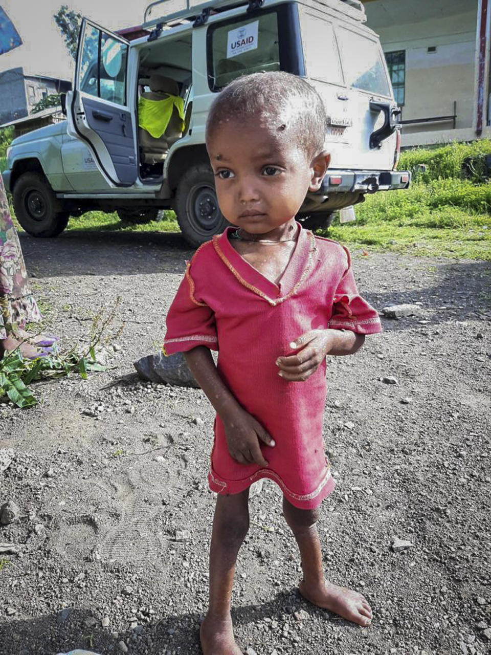 In this photo provided anonymously, a severely malnourished child is seen at the Ayder Referral Hospital, where medicines have almost run out and hospital staffers haven't been paid since June, in Mekele, in the Tigray region of northern Ethiopia in September 2021. For months, the United Nations has warned of famine in Tigray and now internal documents and witness accounts reveal the first starvation deaths since Ethiopia's government in June imposed what the U.N. calls "a de facto humanitarian aid blockade." (UGC via AP)