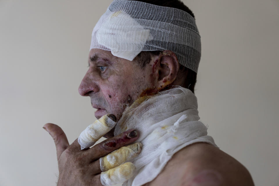 Burns cover 30% of Dmytro Yarmolchuk's body. The 50-year-old Ukrainian soldier, who is being treated at St. Panteleimon hospital, was hit by an anti-tank missile in the battle for P'yatykhatky. He shows his wounds at the hospital n Lviv, Ukraine, Wednesday, July 26, 2023. Ukraine is facing the prospect of a future with upwards of 20,000 amputees, many of them soldiers who are also suffering psychological trauma from their time at the front. (AP Photo/Evgeniy Maloletka)