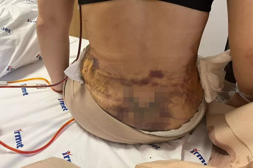 Woman's black scarring around stomach