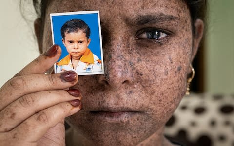 Sadiya Hamza, 12, holds a photo of herself before the Xeroderma pigmentosum fully manifested itself - Credit: Simon Townsley/The Telegraph