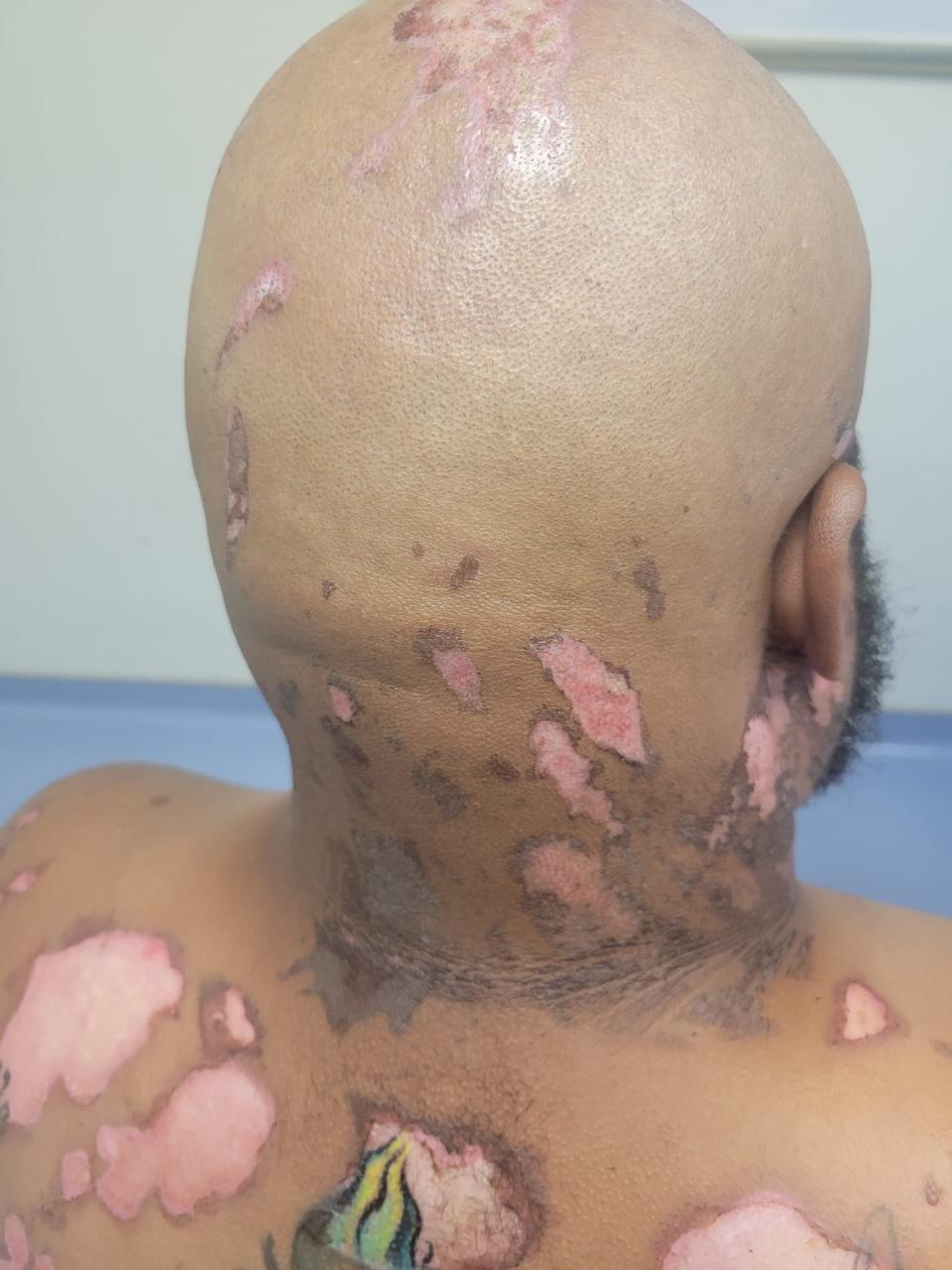 While Kahlil Floyd's lower body sustained the worst burns, photographs of which are too severe to publish, the burns to his head can be seen in this image captured less than a week after the accident in Wilmington.