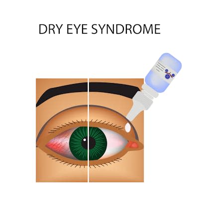 Future therapies to treat dry eye disease may contain microbes engineered to live on the eye and supply therapeutic chemicals. <a href="https://www.shutterstock.com/image-illustration/conjunctivitis-redness-inflammation-eye-vessels-drops-725446807?src=PyhVGh42YKM1-4m3znN5Og-1-18&studio=1" rel="nofollow noopener" target="_blank" data-ylk="slk:Timonina/Shutterstock.com;elm:context_link;itc:0;sec:content-canvas" class="link ">Timonina/Shutterstock.com</a>