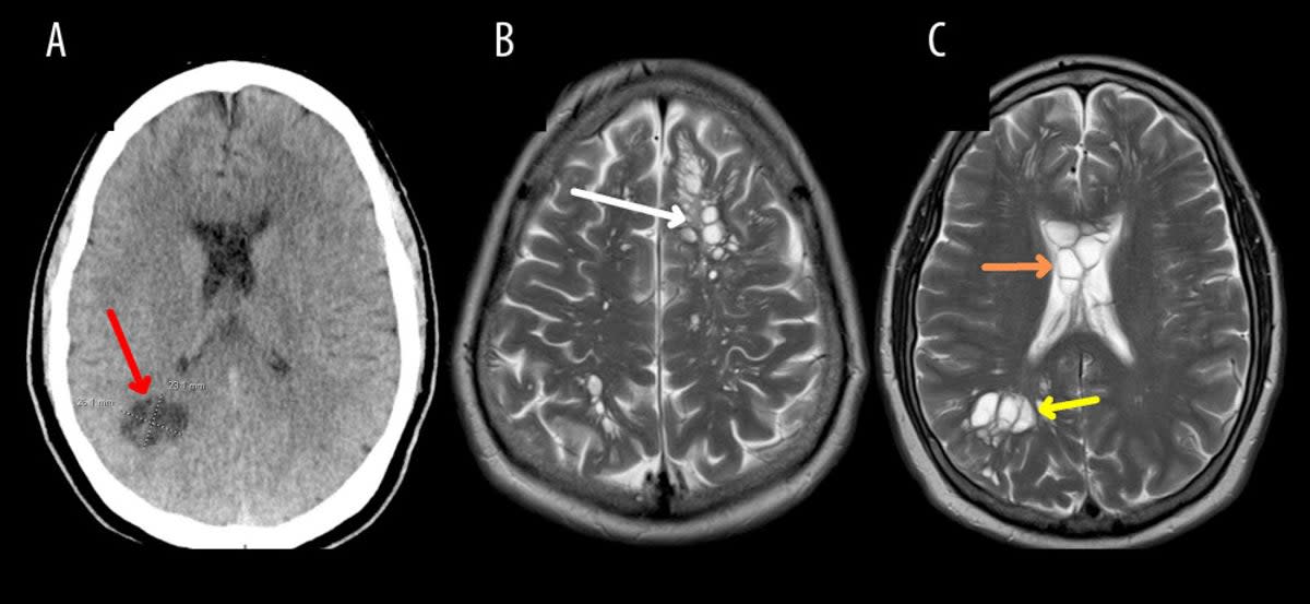 The cysticercosis patient’s brain scan results (American Journal of Case Reports)