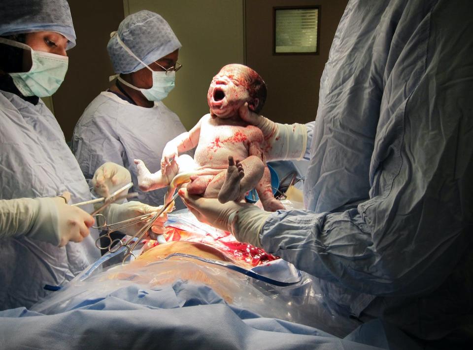 Parents may need to process even a normal childbirth with healthy outcomes. <a href="https://www.gettyimages.com/detail/photo/caesarian-babys-first-breath-royalty-free-image/125951777" rel="nofollow noopener" target="_blank" data-ylk="slk:Peter Dazeley/The Image Bank via Getty Images;elm:context_link;itc:0;sec:content-canvas" class="link ">Peter Dazeley/The Image Bank via Getty Images</a>