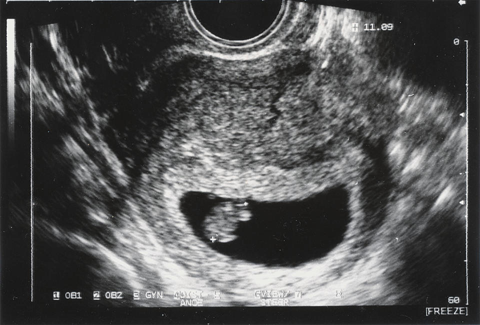 Baby Roe was at the same point of pregnancy as this ultrasound image taken at six weeks when her mother had an abortion. Pictured is a stock image. Source: Getty Images