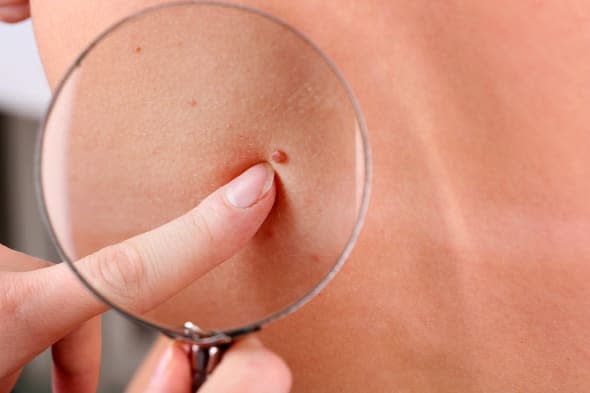 Dermatologist examines a birthmark of patient, close up