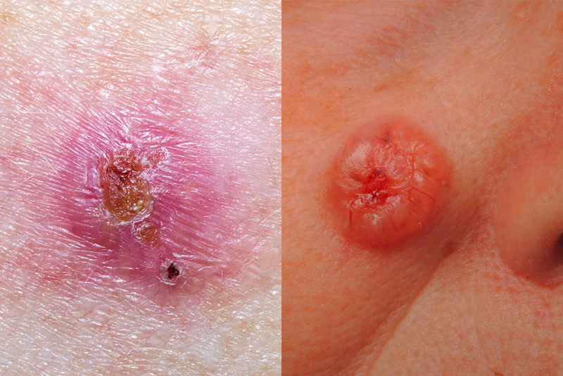 basal cell carcinoma skin cancer pictures