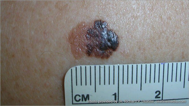 skin cancer pictures: photo of a melanoma