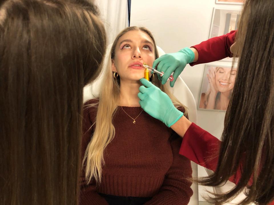 lip filler experience